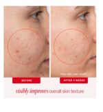 ⁦Acne Clearing Pads – 2% Salicylic Acid Acne Treatment⁩ - الصورة ⁦3⁩